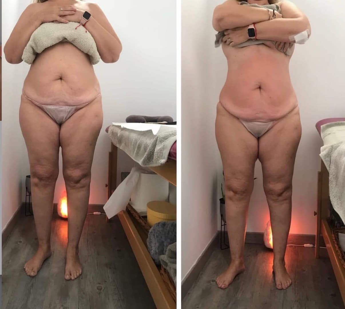 Comparación de antes y después de un tratamiento estético corporal en abdomen y piernas.