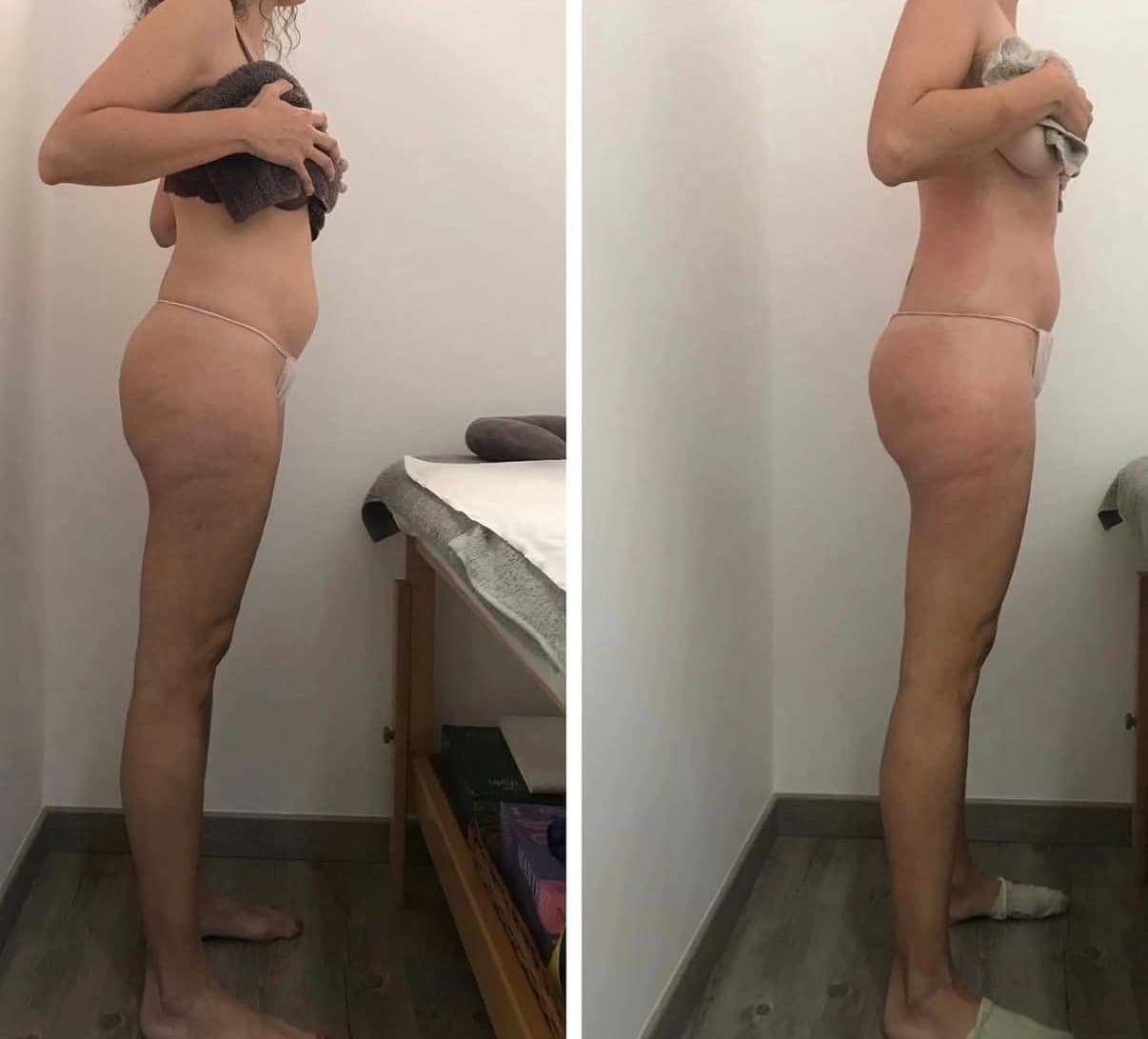 Vista lateral de una mujer antes y después de un tratamiento estético reductor y reafirmante.