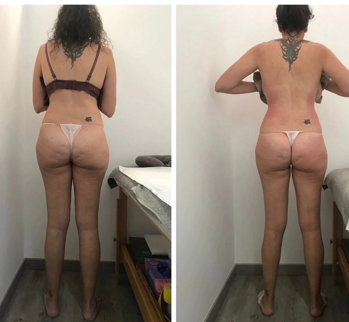 Comparativa de antes y después de un tratamiento estético en la espalda, glúteos y piernas.