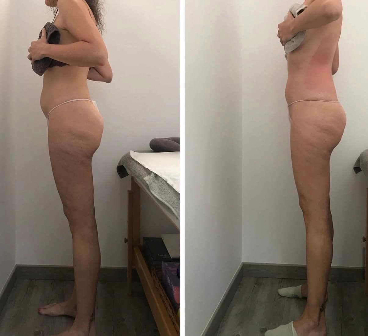 Comparación de perfil lateral de una mujer antes y después de un tratamiento corporal estético.